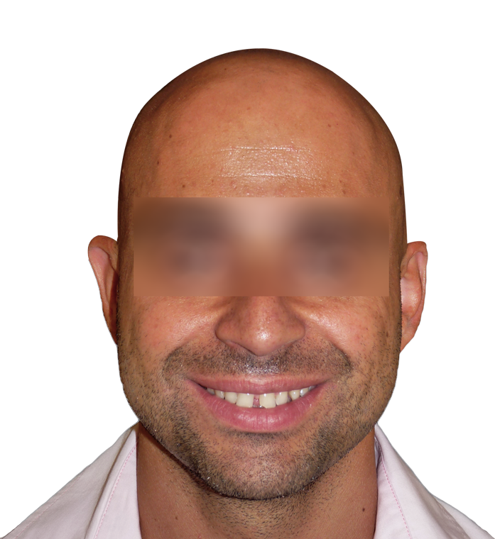 diastema diastema