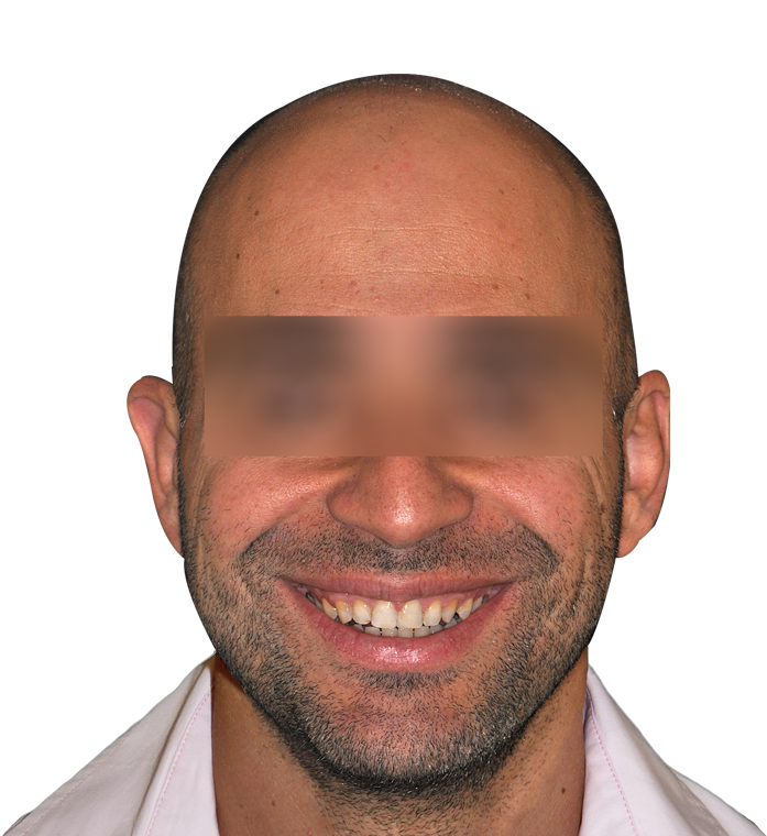 diastema diastema