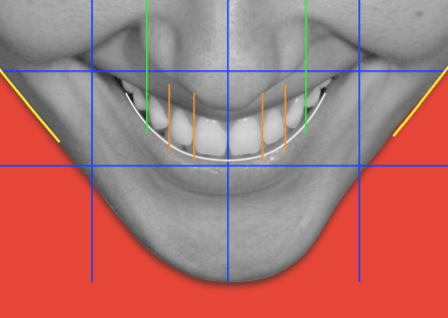diastema