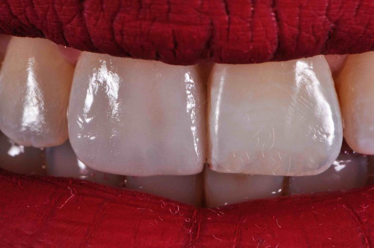 Anche da vicinissimo i materiali scelti per le faccette dentali non devono sembrare poco naturali