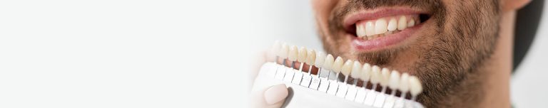 Faccette dentali