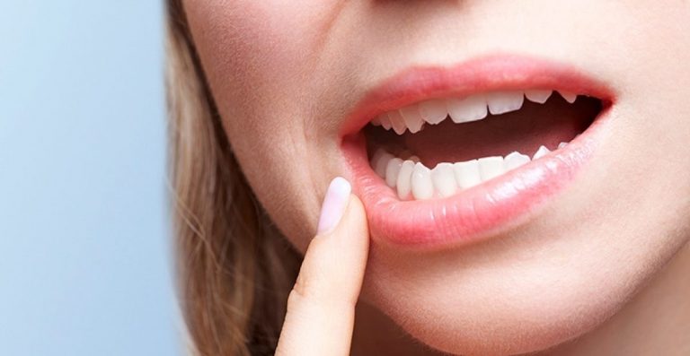 Gengivite - Dottor Gallone