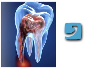 dolore dopo devitalizzazione