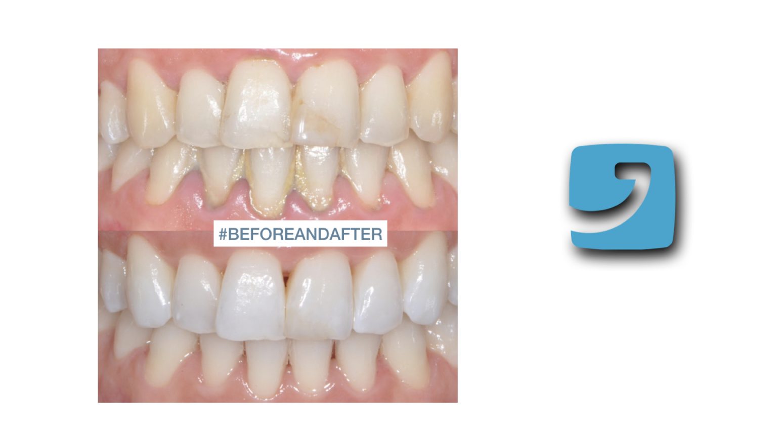 Specchio Dentale Raschietto Pr-006 Set Raschietto Per Tartaro Dentale - Kit Con Specchio Dentale E Scaler Per Igiene Orale, Modello PR-006 Occhiali