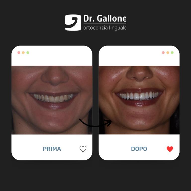 Risultati dell'ortodonzia Linguale - Ortodonzia Linguale Gallone-3