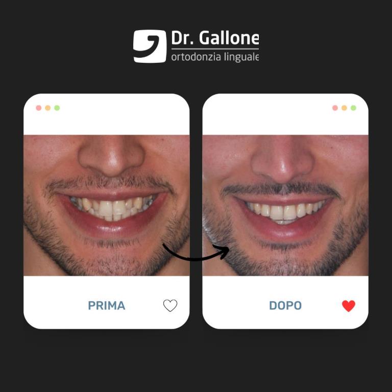 Risultati dell'ortodonzia Linguale - Ortodonzia Linguale Gallone-5