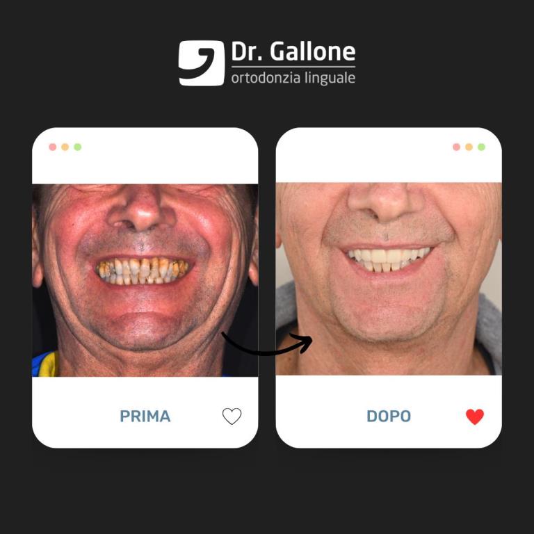 Denti fissi in giornata - Dr Gallone2
