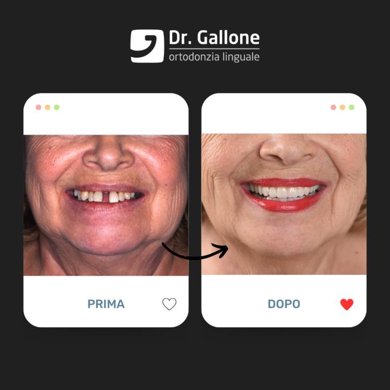 Denti fissi in giornata - Dr Gallone3