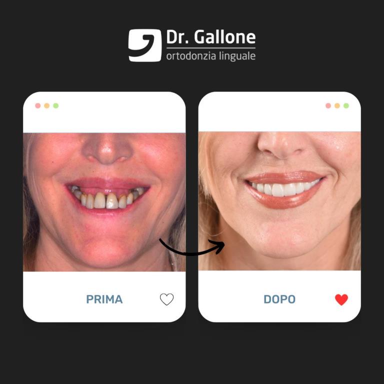 Denti fissi in giornata - Dr Gallone4
