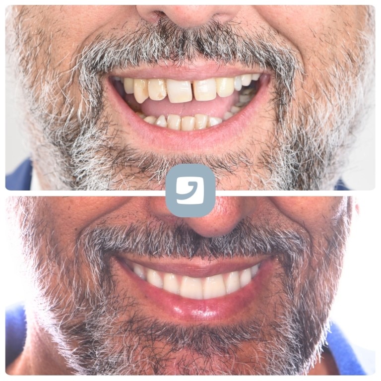 Denti Fissi Catania - Ortodonzia Linguale2