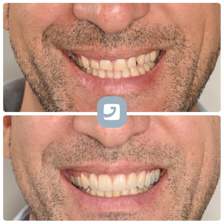 Faccette-Dentali-Ortodonzia-Linguale-Catania-4