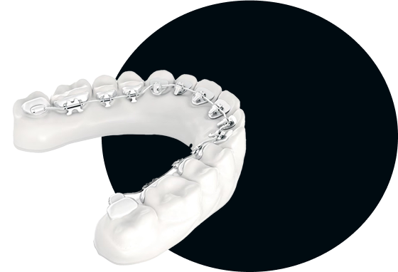 dentista-gallone-catania-ortodonzia-linguale-grafiche