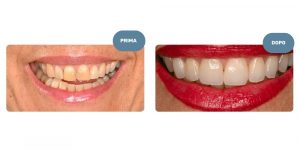 Faccette Dentali Catania - Dr Gallone