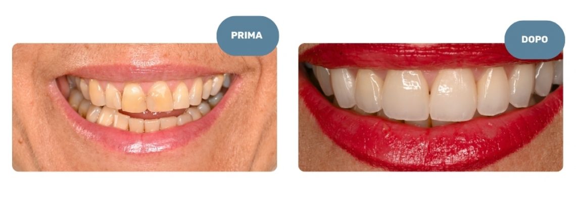 Faccette Dentali Catania - Dr Gallone