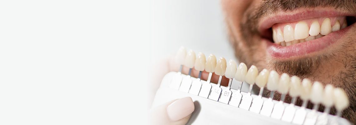 Faccette dentali