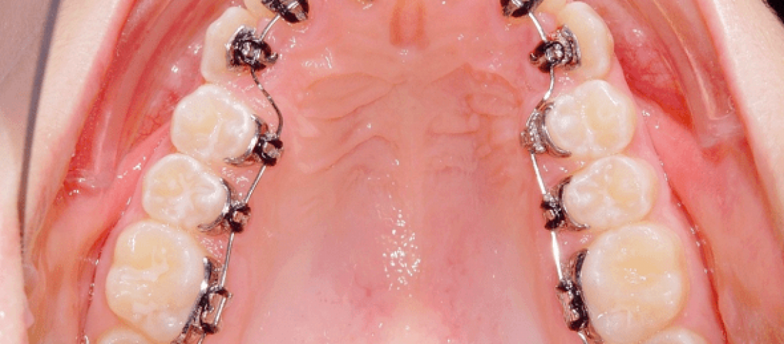 ortodonzia linguale con attacchi