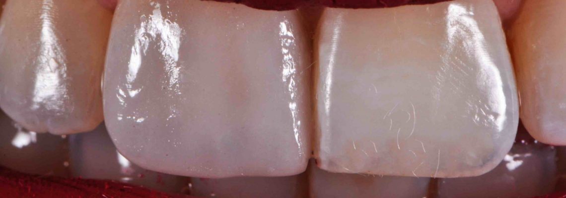 Anche da vicinissimo i materiali scelti per le faccette dentali non devono sembrare poco naturali